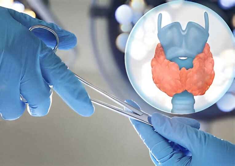 Cirurgia da Tireoide