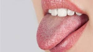 Boca Seca Após Radioterapia