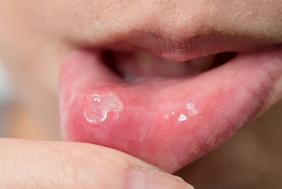 Feridas na Boca que Não Cicatrizam