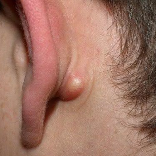 Nódulo Atrás da Orelha