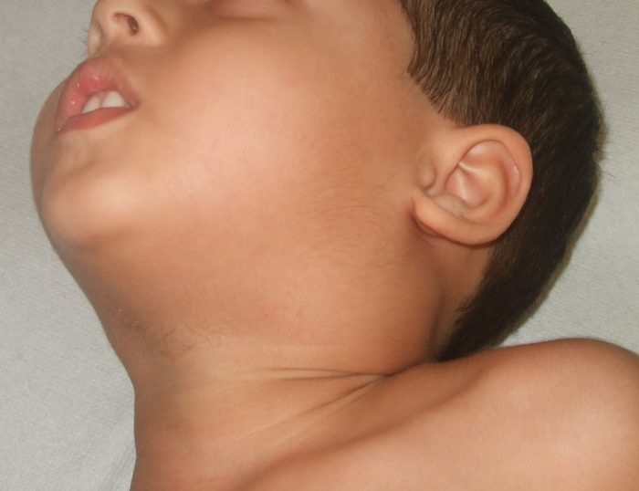 Inchaço no pescoço em crianças: o que observar