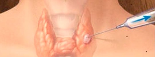 Biópsia de Linfonodo