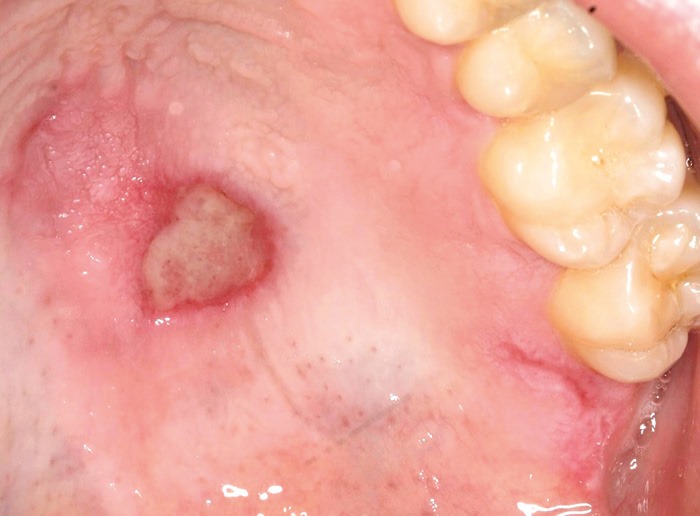 Lesão na Cavidade Oral