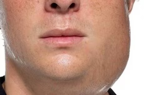 Glândula salivar inchada