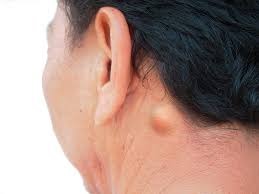 nódulo indolor adulto