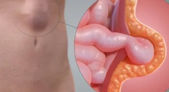 Nódulo com secreção