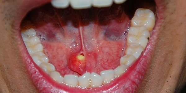 Nódulo que aparece e desaparece: o que pode ser?