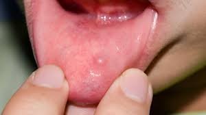 Nódulo na garganta que dói