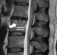 Nódulo esclerótico na coluna