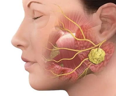 Caroço na região submandibular