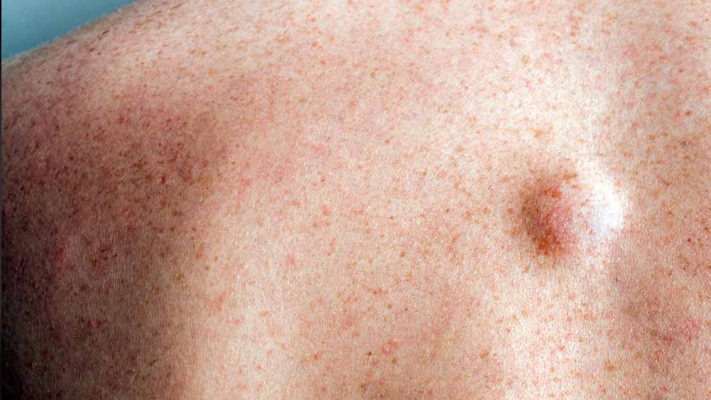 Nódulo indolor crescendo lentamente