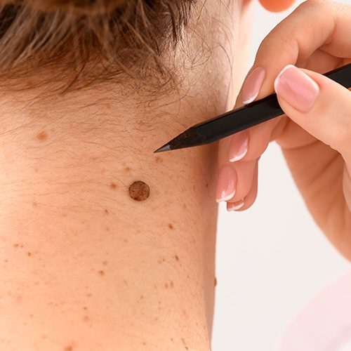 Diagnóstico de carcinoma espinocelular em região cervical