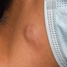 linfonodos na virilha
