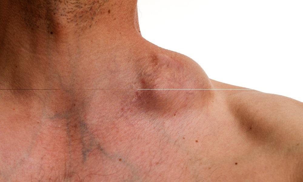 linfonodo inchado é câncer
