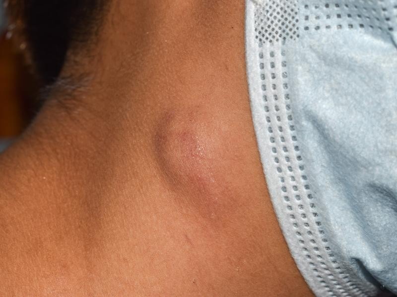 linfonodos inflamados
