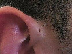 Linfonodo pré-auricular inchado: causas