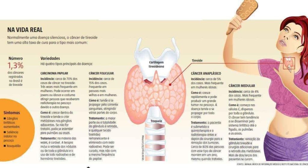 Tipos de Câncer de Tireoide