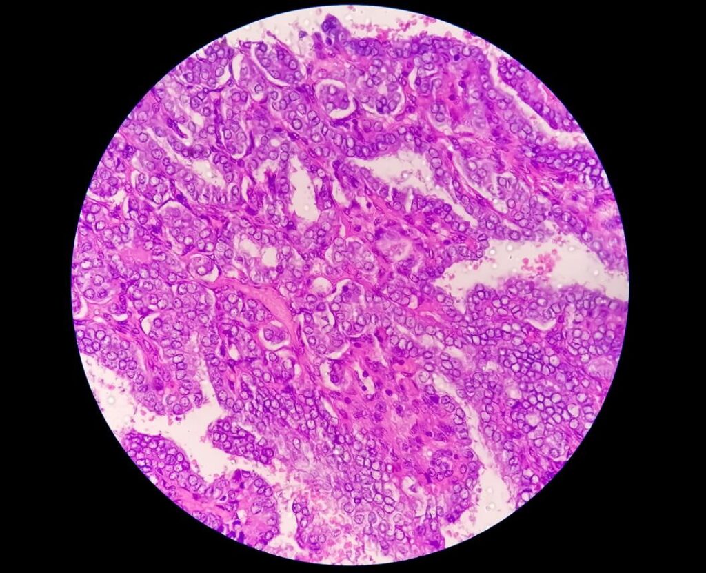 Tipos de Câncer de Tireoide