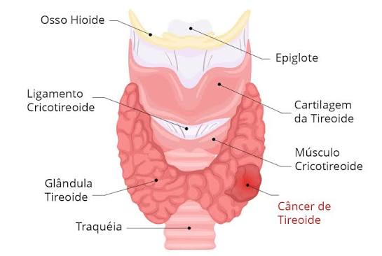 Linfonodos no Câncer de Tireoide
