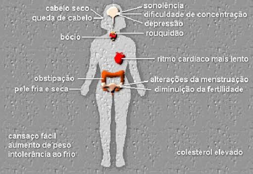 Hipotireoidismo