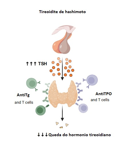 Tireoidite de Hashimoto