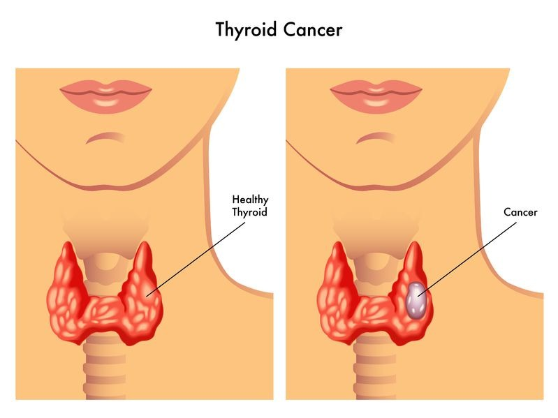 Riscos da Cirurgia da Tireoide